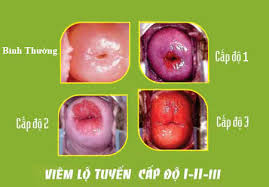 muc-do-cua-viem-lo-tuyen-co-tu-cung